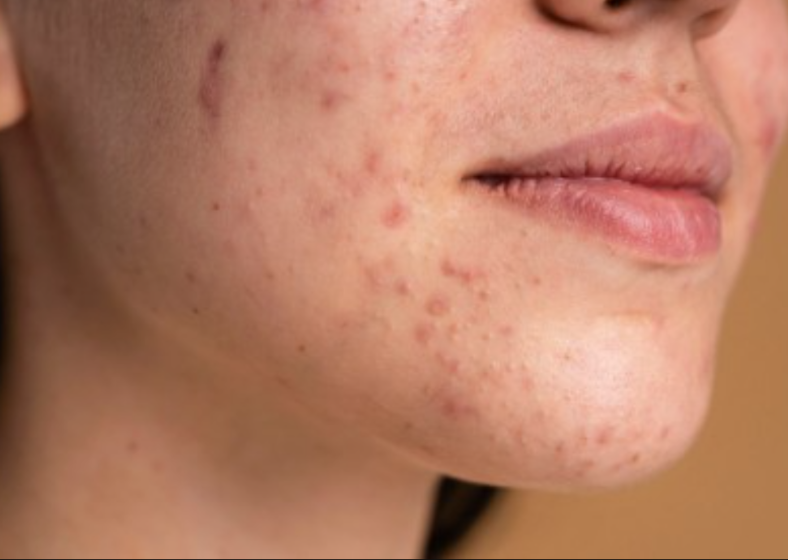 A terapia com luz azul tem demonstrado potencial no tratamento da acne por suas propriedades antimicrobianas e anti-inflamatórias. 